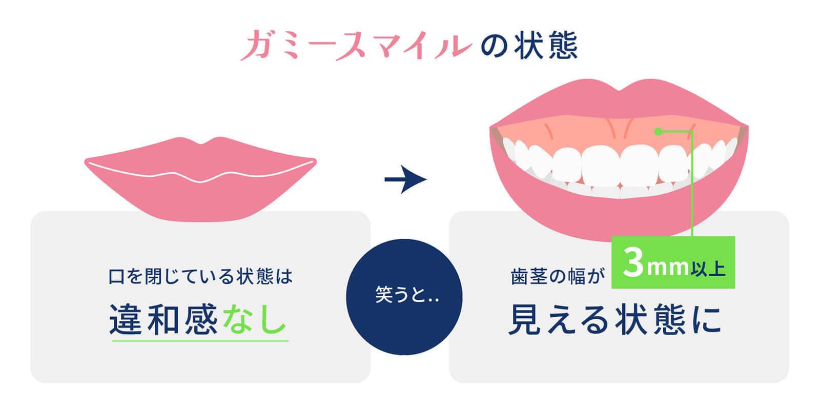 ガミースマイルの状態